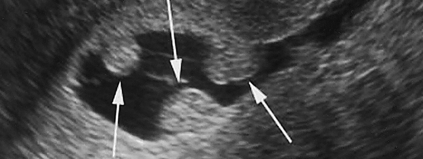 Fluid-in-endometrial-cavity-Patient-from-Gwalior
